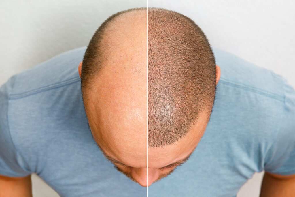 Best Age for a Hair Transplant