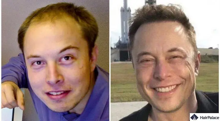elon musk before after hair transplant results