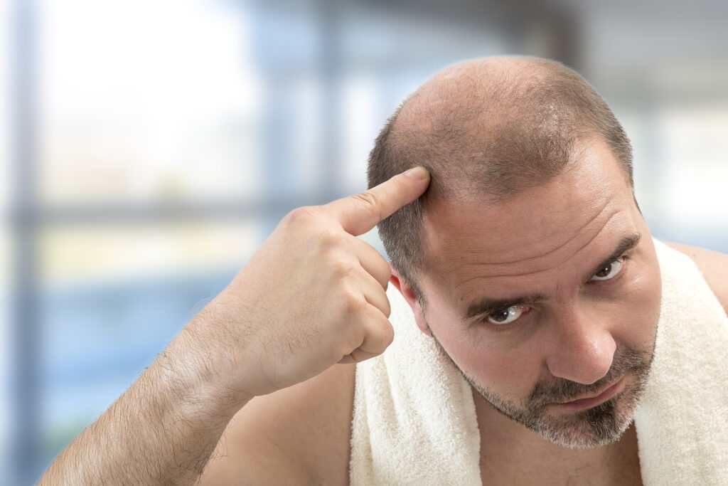 Can Anything Be Done to Slow Down the Balding Process?
