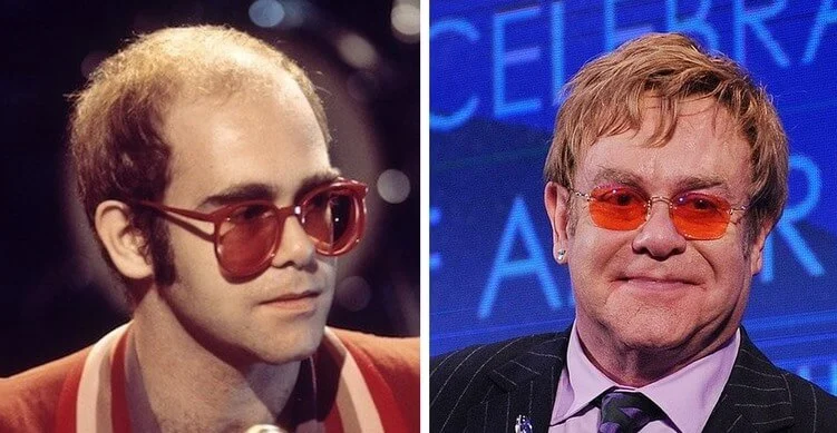 Elton Johns Hair transplant