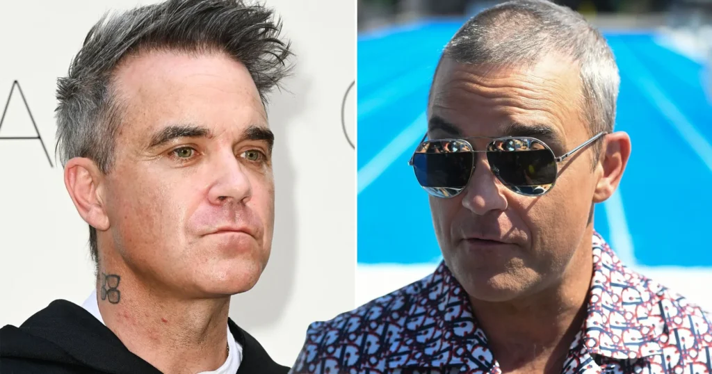 Robbie Williamss hair transplant 1