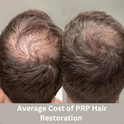 Average Cost of PRP Hair Restoration