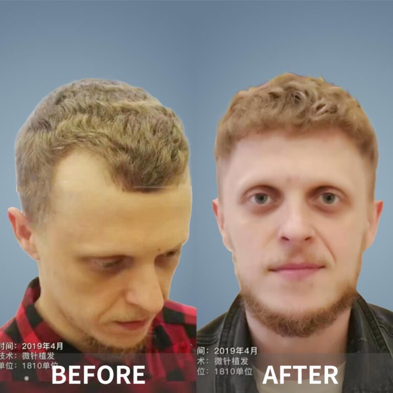 Advanced Hair Restoration 