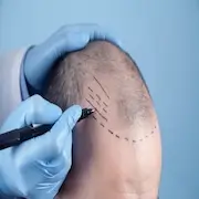 Hair Transplant on Scar: All You need to know about Hair Transplants 