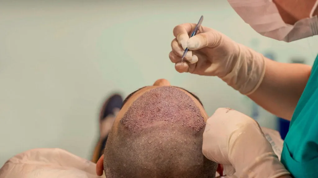 Latest Technology in Hair Transplant